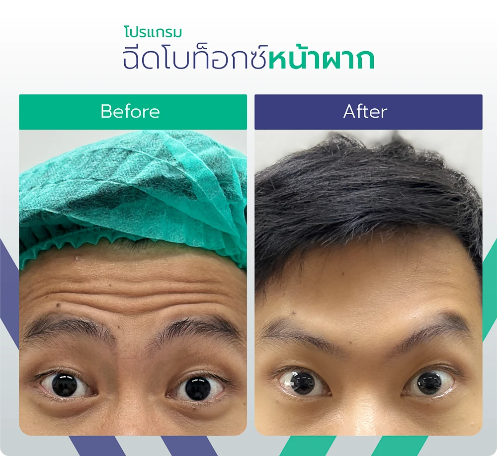 Botox-BeforeAfter-1