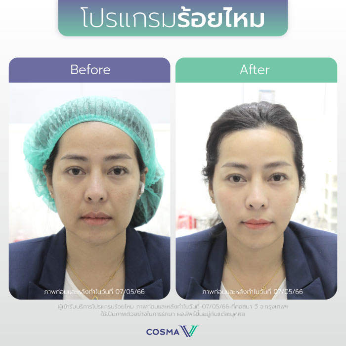 ร้อยไหม_REVIEW