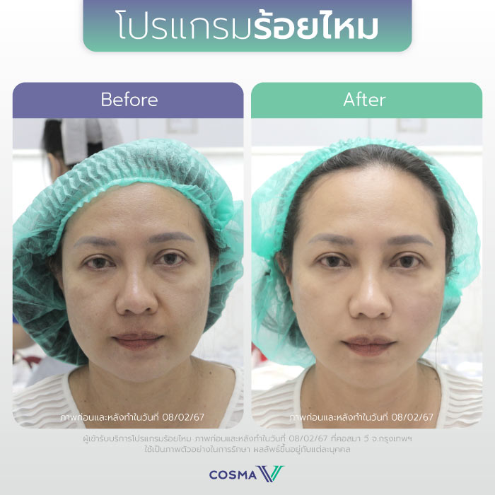ร้อยไหม_REVIEW2