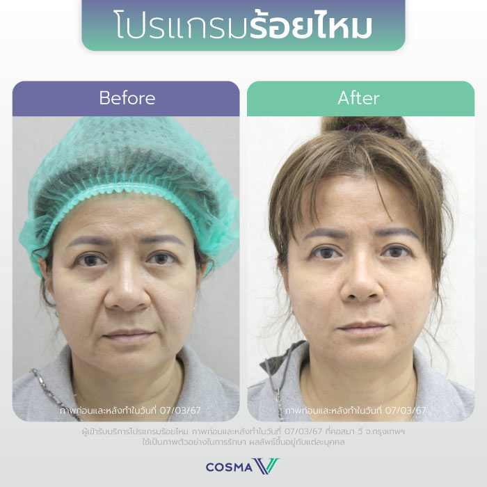 ร้อยไหม_REVIEW3